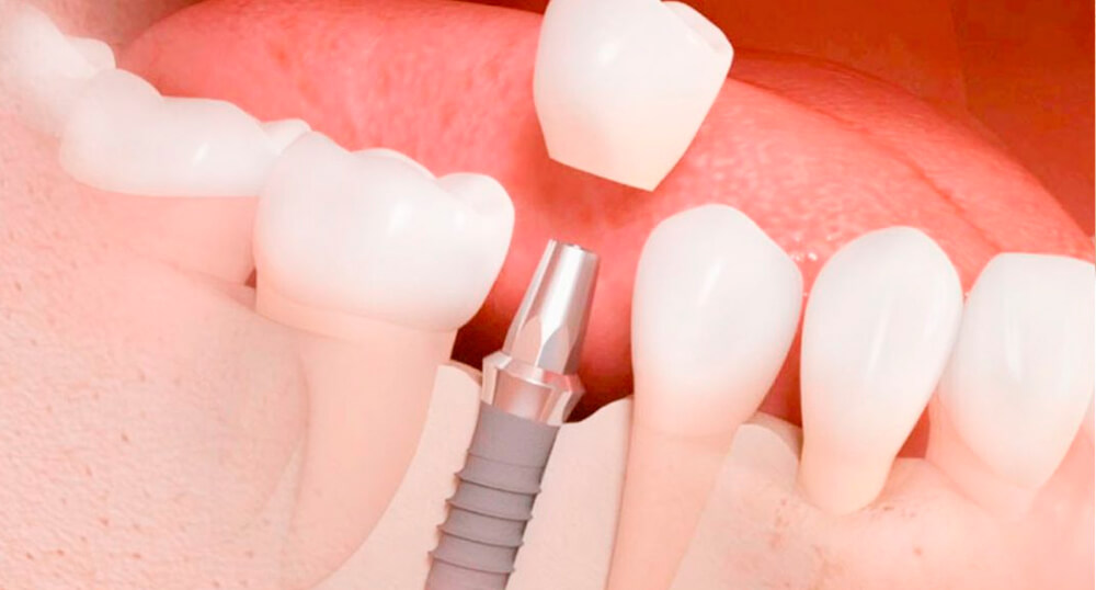 implantes-dentales-barcelona
